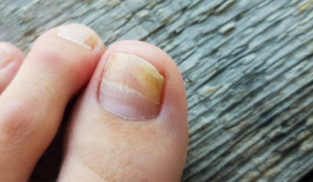 Ontstoken nagelriem