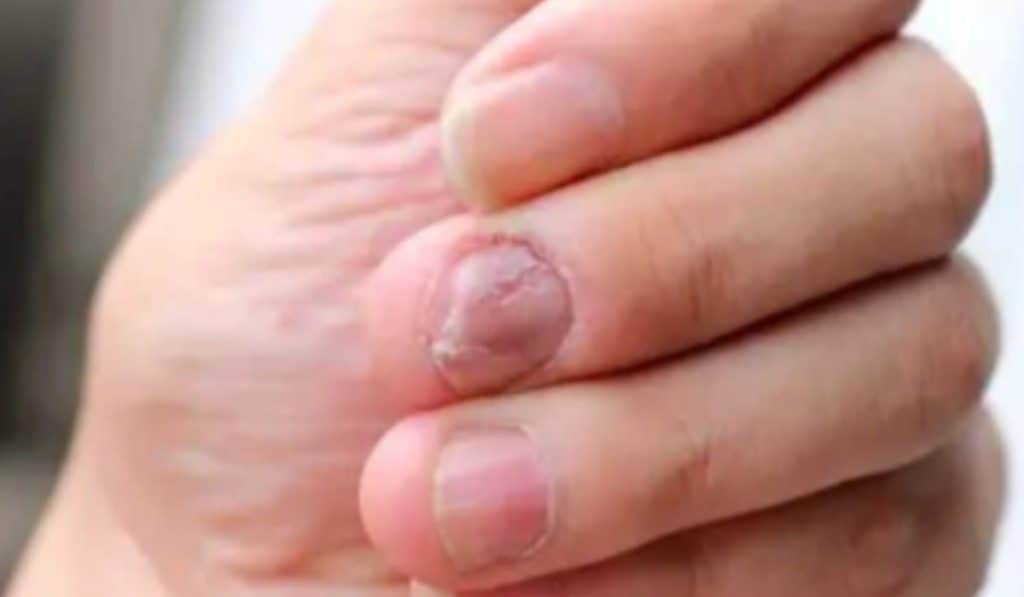 Ontstoken nagelriem